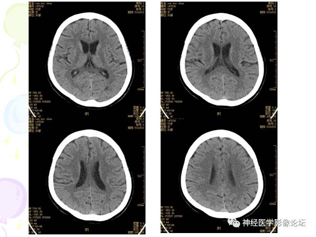 【病例】易误诊为多发性硬化的脑囊虫病1例CT及MR