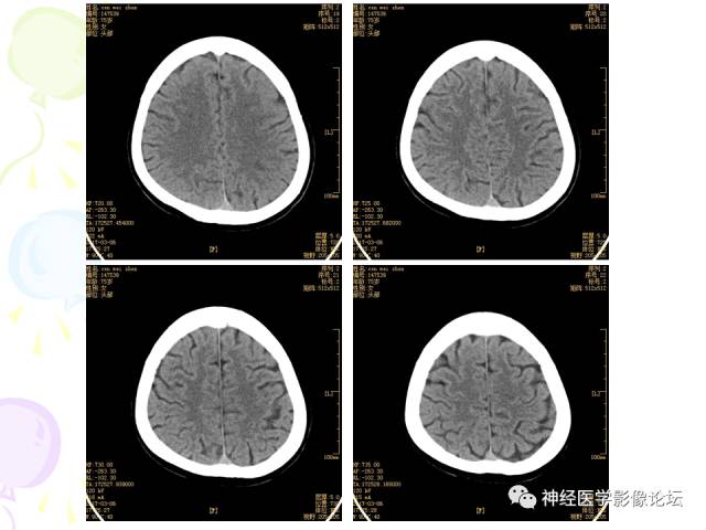 【病例】易误诊为多发性硬化的脑囊虫病1例CT及MR