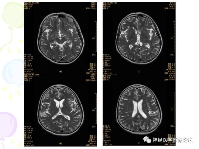 【病例】易误诊为多发性硬化的脑囊虫病1例CT及MR