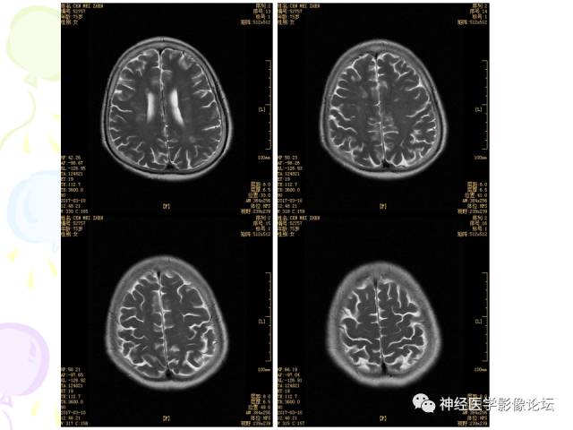 【病例】易误诊为多发性硬化的脑囊虫病1例CT及MR