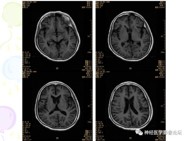 【病例】易误诊为多发性硬化的脑囊虫病1例CT及MR