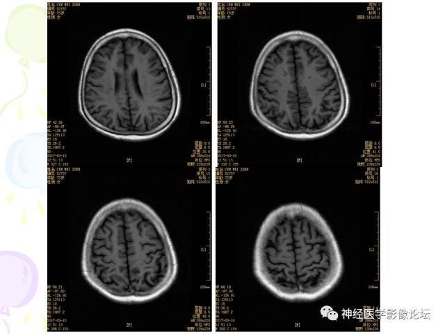 【病例】易误诊为多发性硬化的脑囊虫病1例CT及MR