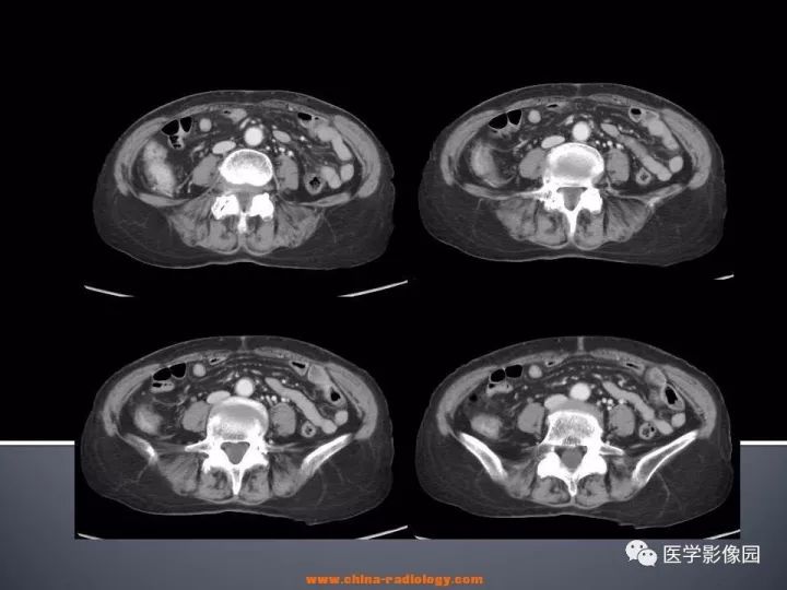 【病例】乏脂肪肾血管平滑肌脂肪瘤1例CT影像表现