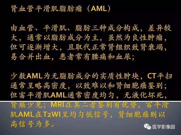【病例】乏脂肪肾血管平滑肌脂肪瘤1例CT影像表现
