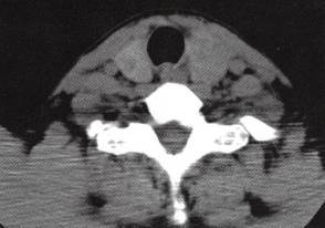 【病例】结节性甲状腺肿1例 【病例】结节性甲状腺肿1例