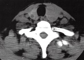 【病例】结节性甲状腺肿1例 【病例】结节性甲状腺肿1例