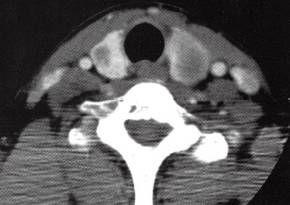 【病例】结节性甲状腺肿1例