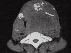 【病例】结节性甲状腺肿恶变1例CT影像表现 【病例】结节性甲状腺肿恶变1例CT影像表现
