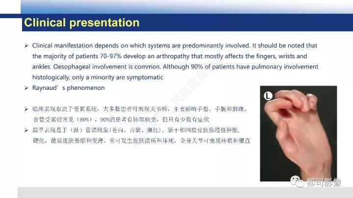 【病例】系统性硬皮病1例骨关节X线影像学表现