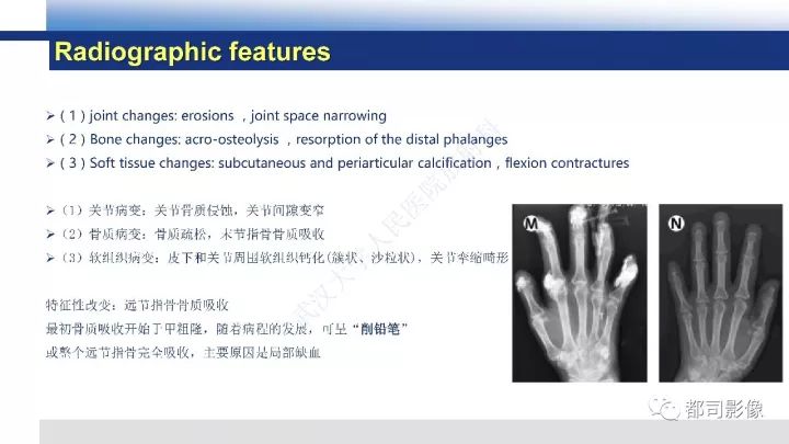 【病例】系统性硬皮病1例骨关节X线影像学表现