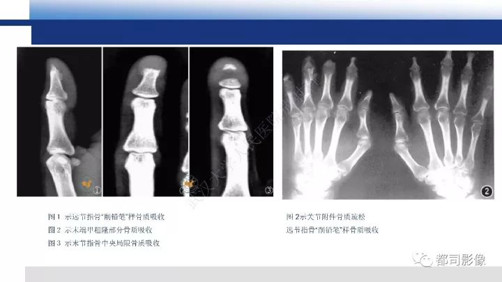 【病例】系统性硬皮病1例骨关节X线影像学表现