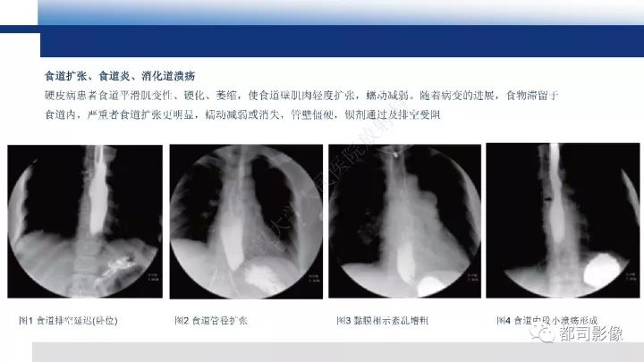 【病例】系统性硬皮病1例骨关节X线影像学表现