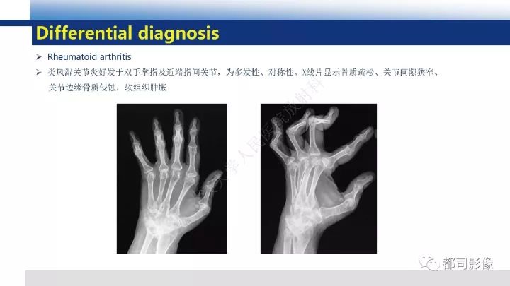【病例】系统性硬皮病1例骨关节X线影像学表现