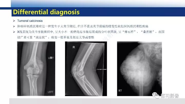 【病例】系统性硬皮病1例骨关节X线影像学表现