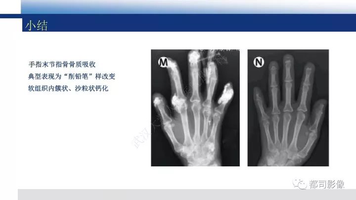 【病例】系统性硬皮病1例骨关节X线影像学表现