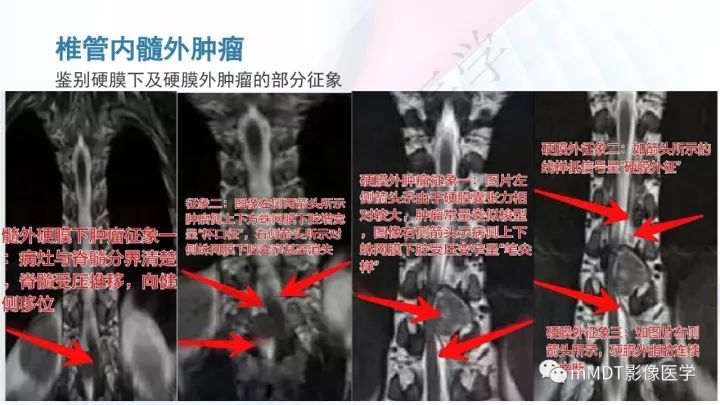 【PPT】椎管内髓外肿瘤