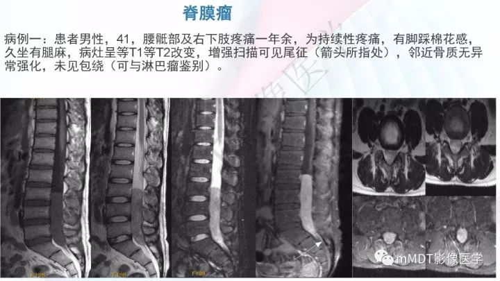 【PPT】椎管内髓外肿瘤