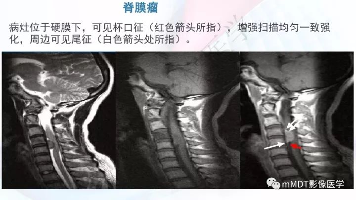 【PPT】椎管内髓外肿瘤