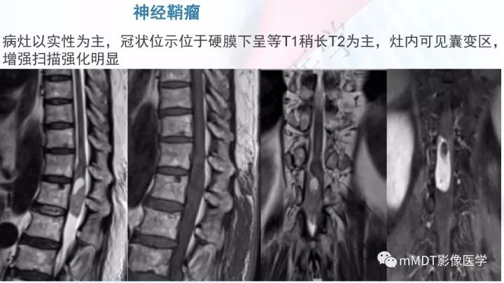 【PPT】椎管内髓外肿瘤