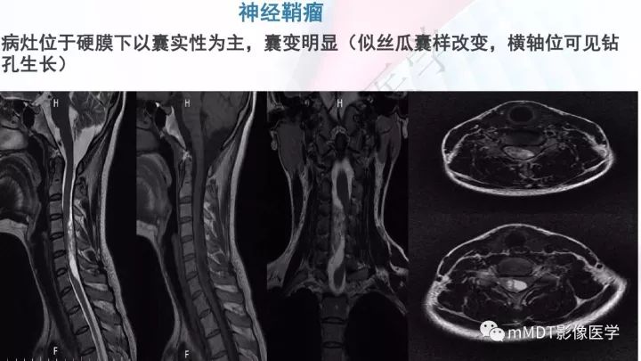 【PPT】椎管内髓外肿瘤