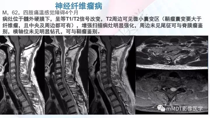【PPT】椎管内髓外肿瘤