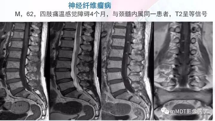 【PPT】椎管内髓外肿瘤
