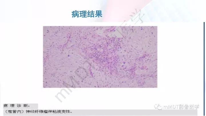 【PPT】椎管内髓外肿瘤