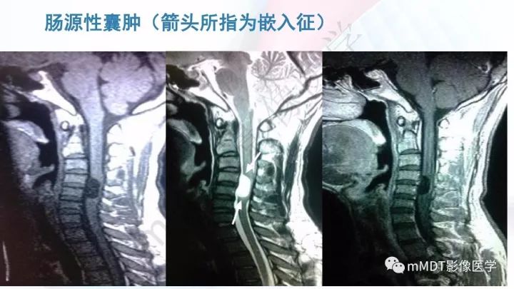 【PPT】椎管内髓外肿瘤