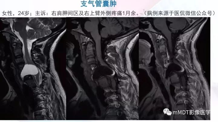 【PPT】椎管内髓外肿瘤