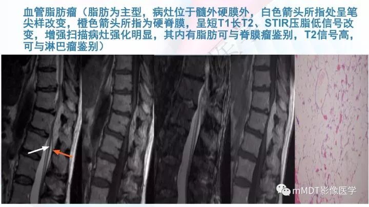 【PPT】椎管内髓外肿瘤
