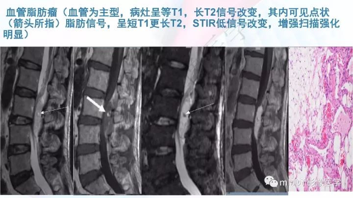 【PPT】椎管内髓外肿瘤