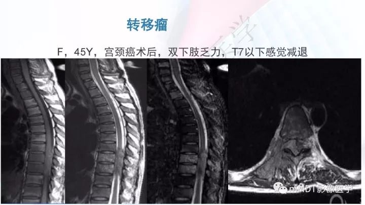 【PPT】椎管内髓外肿瘤