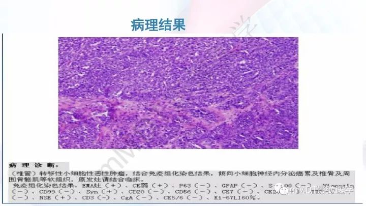 【PPT】椎管内髓外肿瘤