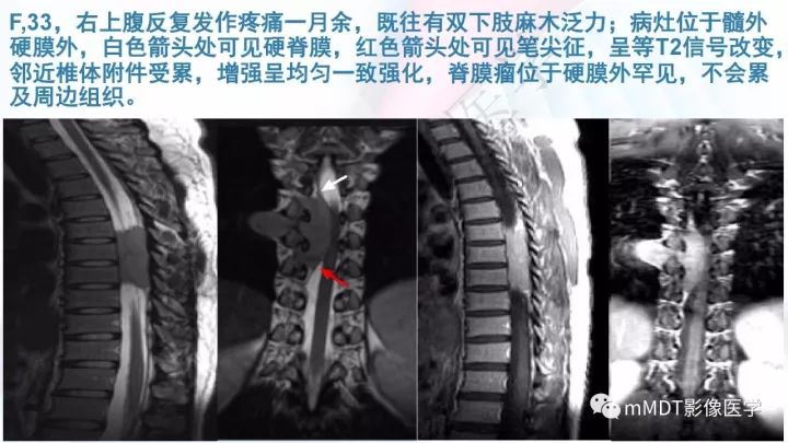 【PPT】椎管内髓外肿瘤