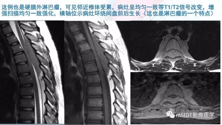 【PPT】椎管内髓外肿瘤