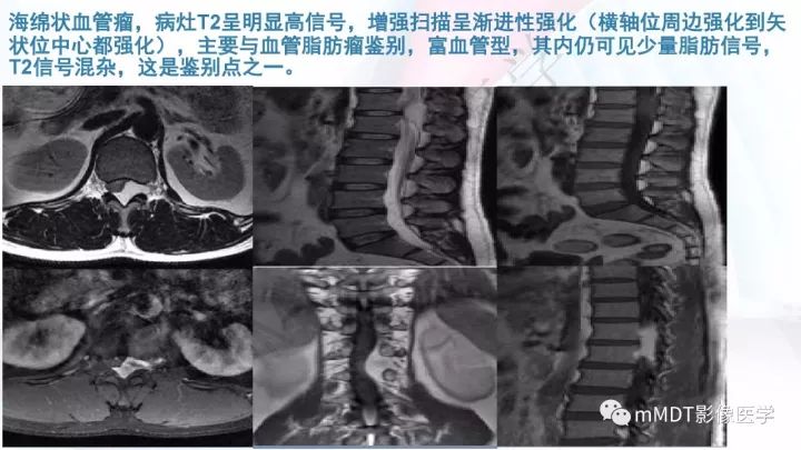 【PPT】椎管内髓外肿瘤