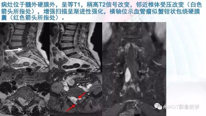 【PPT】椎管内髓外肿瘤
