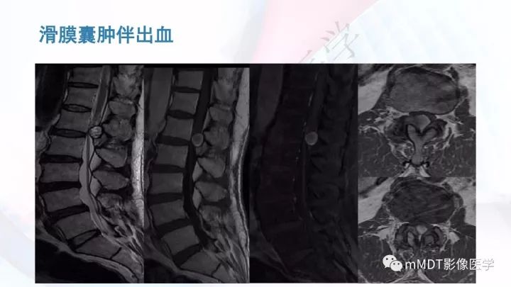 【PPT】椎管内髓外肿瘤