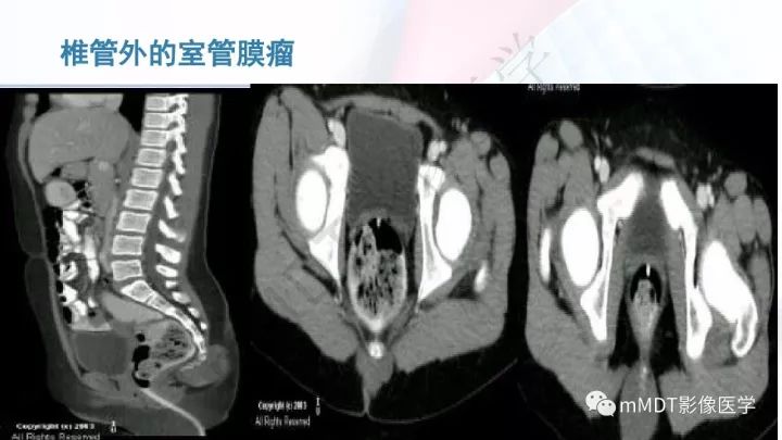 【PPT】椎管内髓外肿瘤