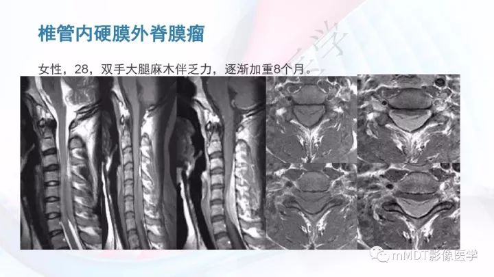 【PPT】椎管内髓外肿瘤
