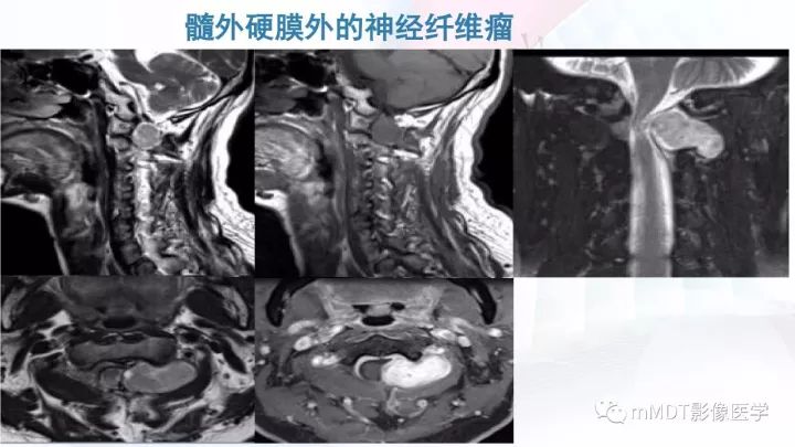 【PPT】椎管内髓外肿瘤