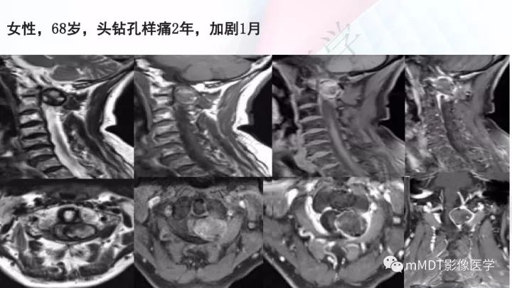 【PPT】椎管内髓外肿瘤
