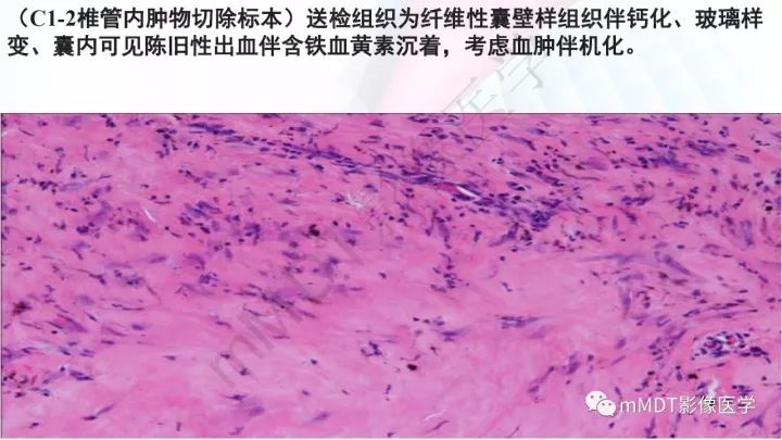 【PPT】椎管内髓外肿瘤