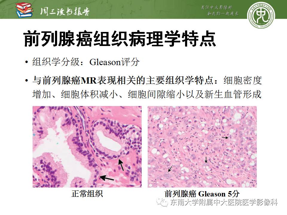【PPT】MR易误诊为前列腺癌的良性表现：影像-病理相关性