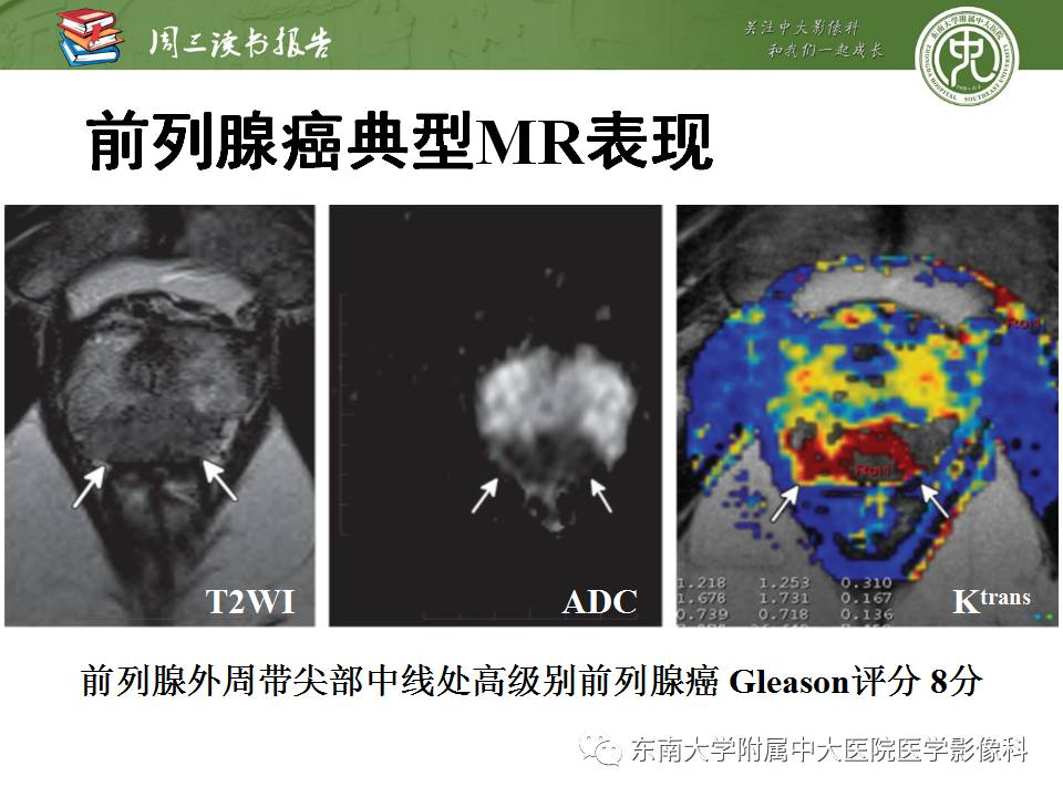 【PPT】MR易误诊为前列腺癌的良性表现：影像-病理相关性