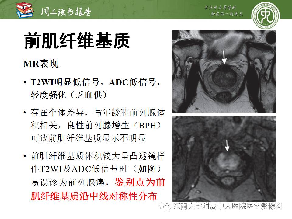 【PPT】MR易误诊为前列腺癌的良性表现：影像-病理相关性
