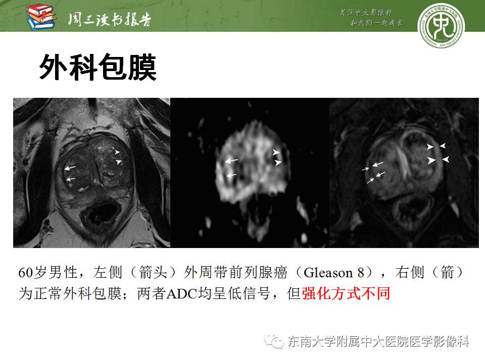 【PPT】MR易误诊为前列腺癌的良性表现：影像-病理相关性