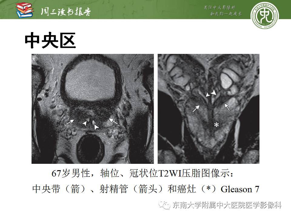 【PPT】MR易误诊为前列腺癌的良性表现：影像-病理相关性