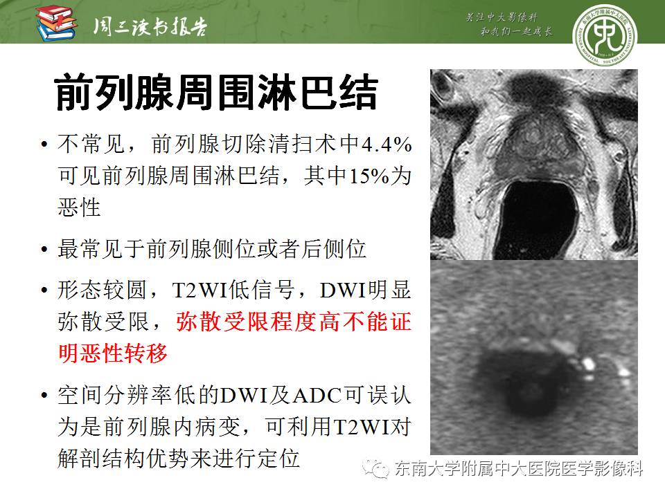 【PPT】MR易误诊为前列腺癌的良性表现：影像-病理相关性