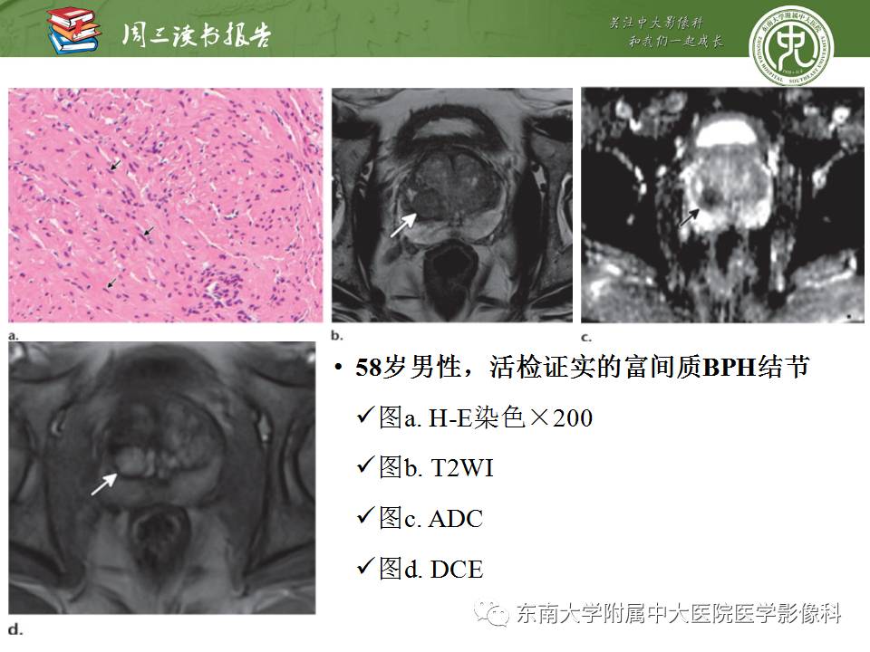 【PPT】MR易误诊为前列腺癌的良性表现：影像-病理相关性